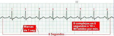 Análisis de señales electrocardiográficas usando técnicas de procesamiento  digital